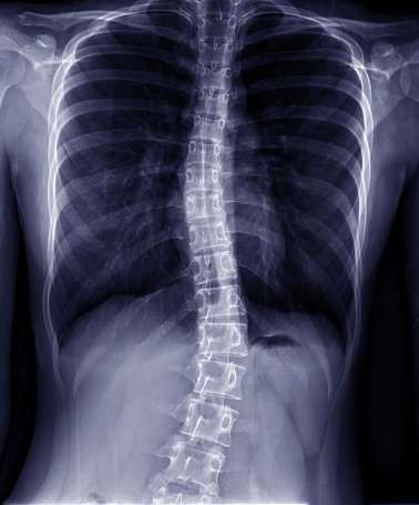 Patologías de la columna vertebral - Escoliosis