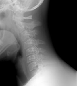 Patologías de la columna vertebral - Mielopatía por cervicoartrosis